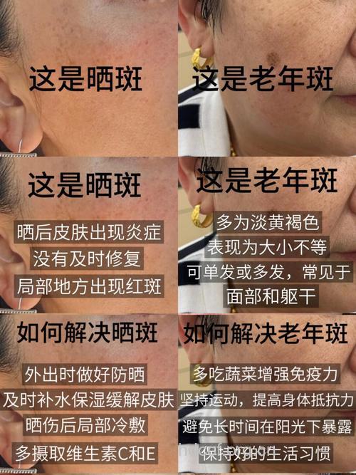 老人的各种色斑与健康关系
