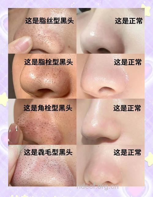 十个最有效的去黑头方法