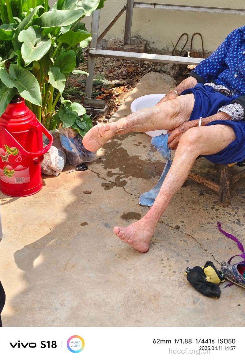 炎热夏季 老人不宜光脚穿凉鞋