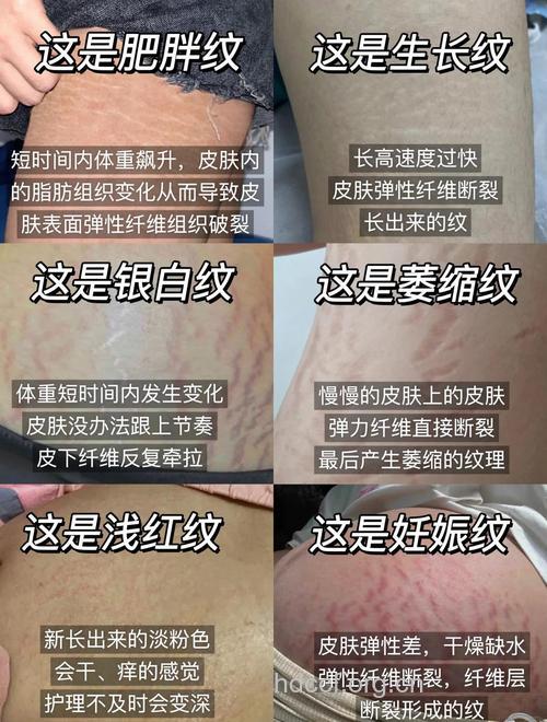 什么人容易长肥胖纹 你有肥胖纹吗