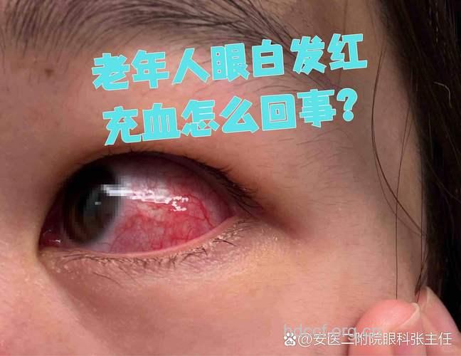 老人眼睛发红要警惕疾病