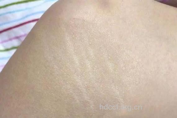 腹部长肥胖纹的原因是什么 要如何消除