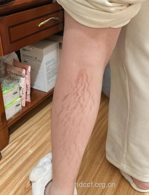 肥胖纹的症状是什么 可以消除吗