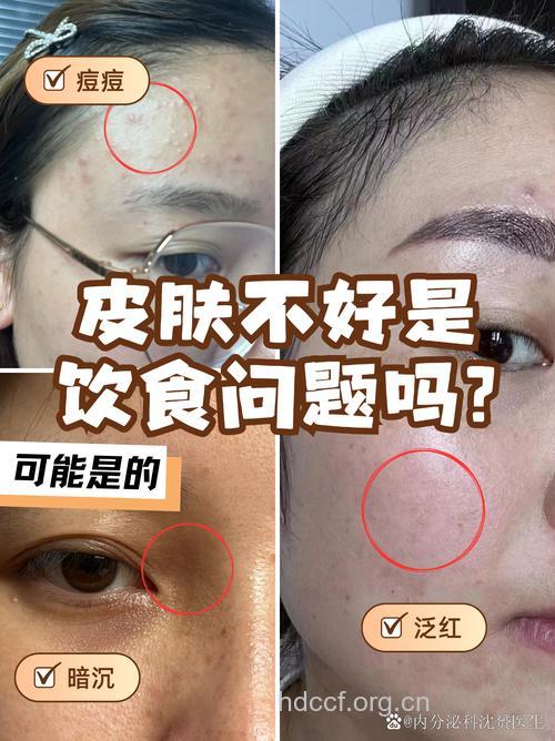 谨慎:营养过剩让皮肤早衰