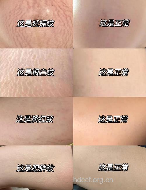 肥胖纹是怎么形成的 激光去除肥胖纹方法