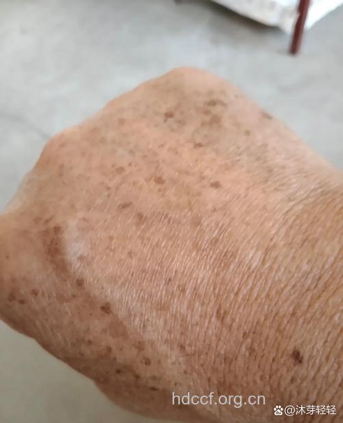 老人多注意皮肤上的老年斑