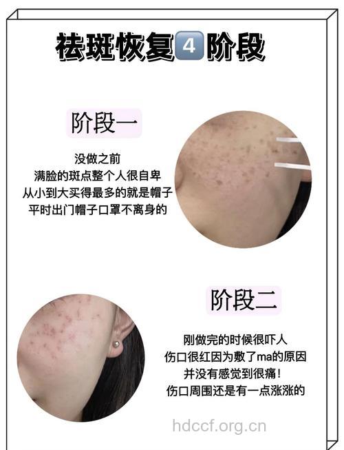 怎么去斑能让肌肤恢复光洁？