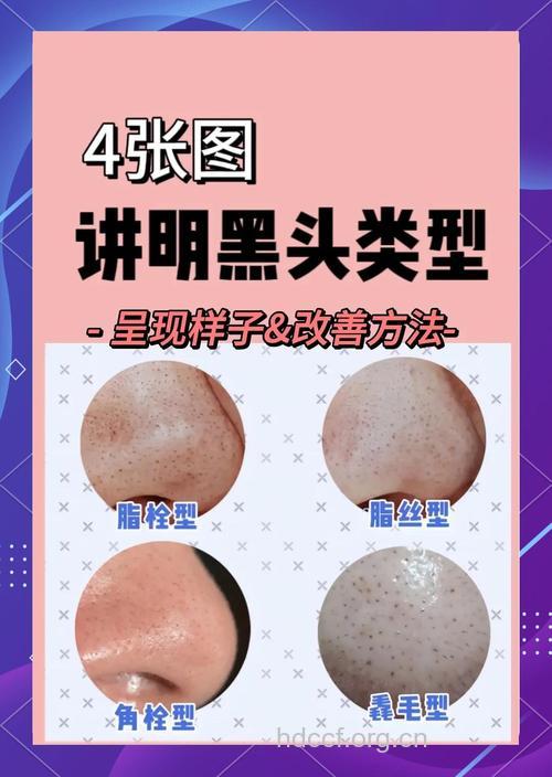 美容护肤知识——黑头