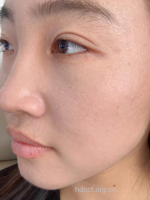 微整形缩毛孔 真人体验曝光