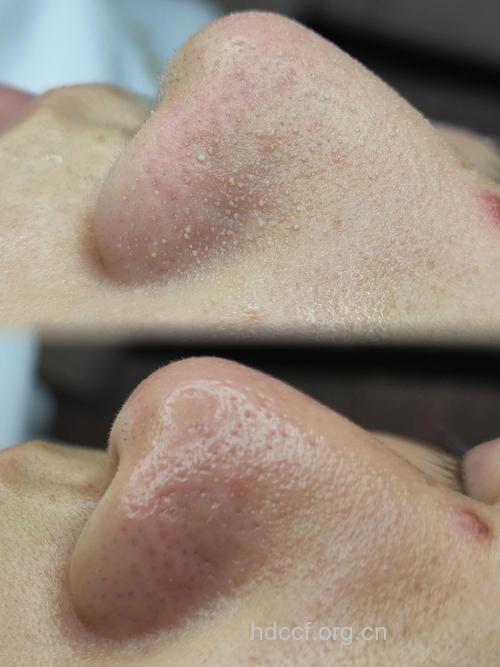 细致毛孔 揪出黑头9大元凶