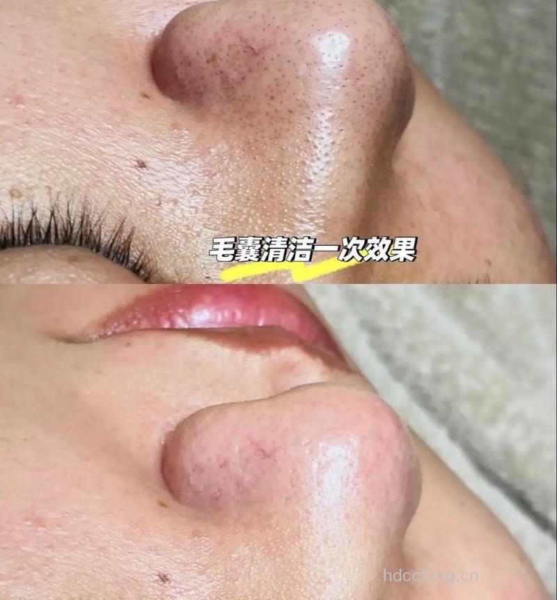 摸清毛孔真相 缩小进行到底