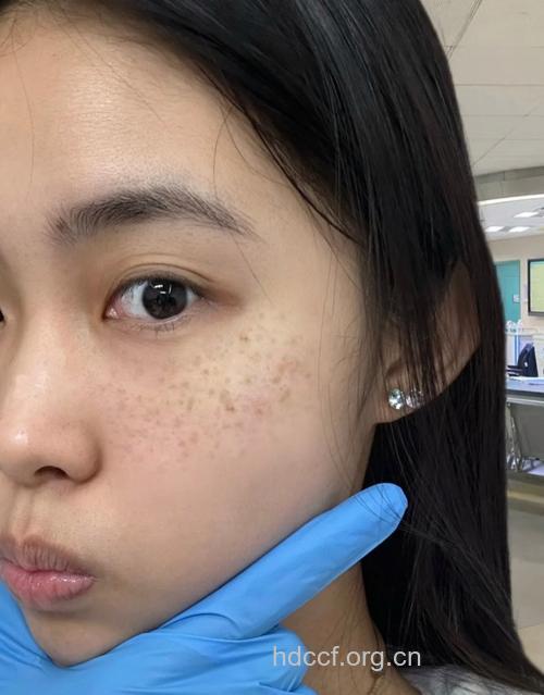 清除色班，让肌肤重现光彩