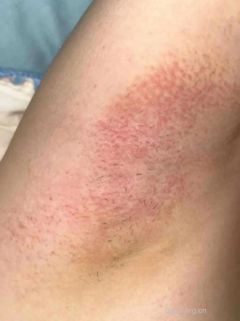 脱毛有哪些并发症