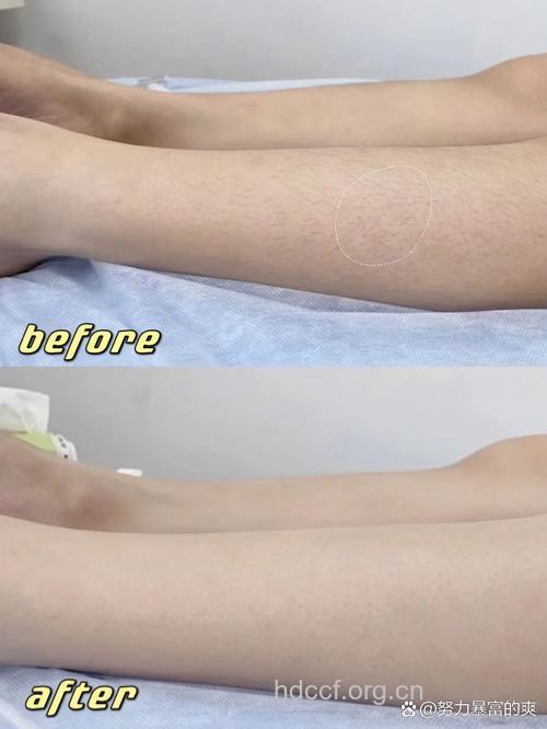 激光脱毛全功略