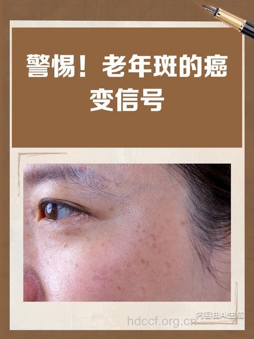 当心老年斑是癌症袭击的信号！