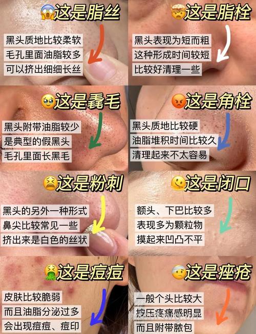 鼻上黑头粗毛孔不可怕 教你有效解决