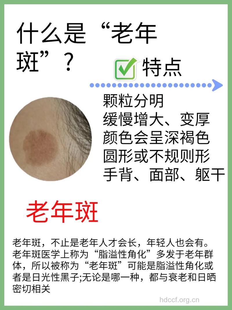 老年斑是只有老人才会长的吗？