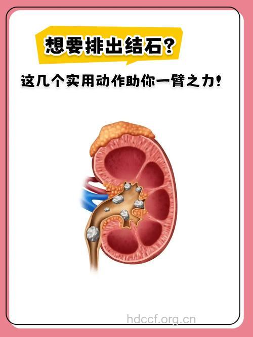 减肥不当小心减出肾结石