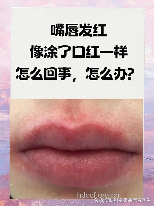 常涂口红可能会得胃癌