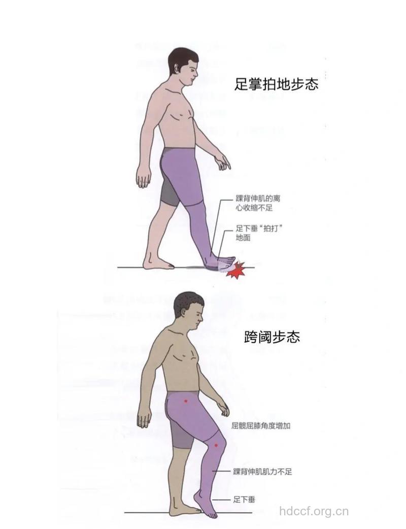 要留心老年人的异常步态