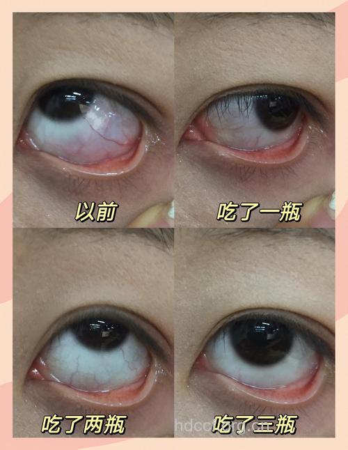 红血丝青睐眼部和脸上 要怎么有效摆脱？
