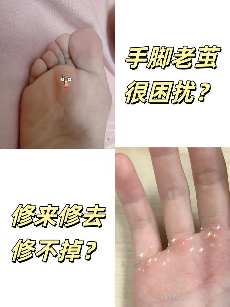 老人脚底的茧太厚怎么软化?