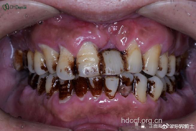 老年人牙齿不洁易诱发肺炎