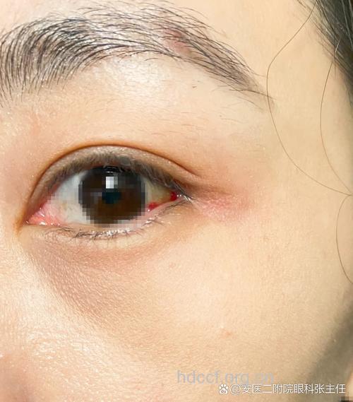 有眼病的人不宜画眼影