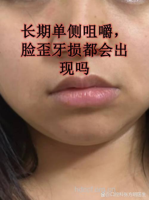 单侧咀嚼食物造成脸颊不对称