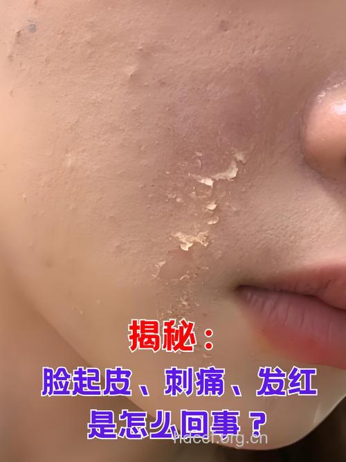 常用吸油面纸损害皮肤