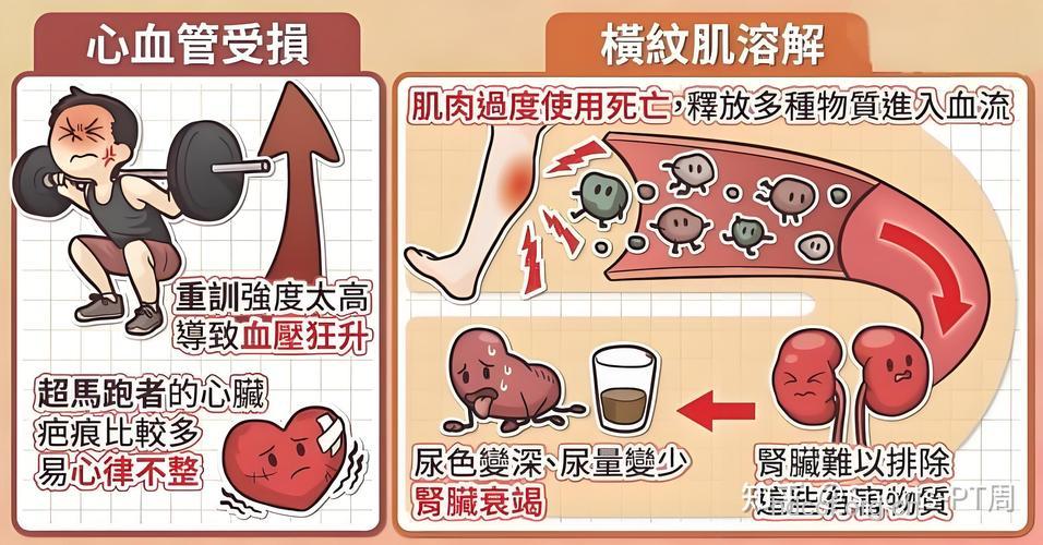 深蹲得横纹肌溶解症 运动量过大危害多