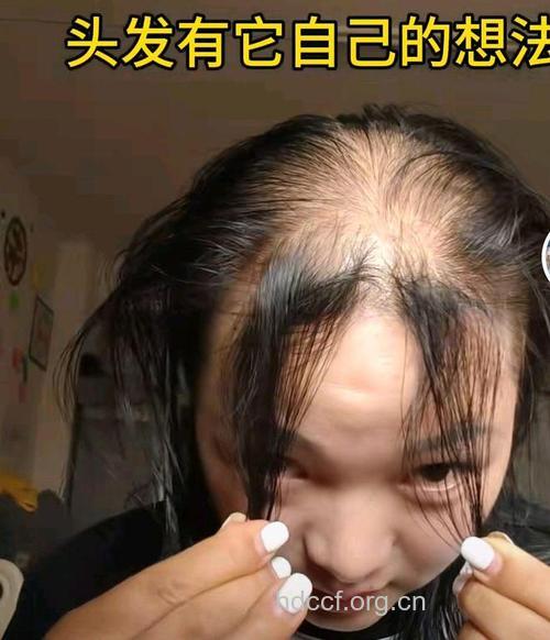 被访减肥女性九成脱发