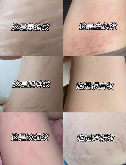 女性为什么会出现肥胖纹