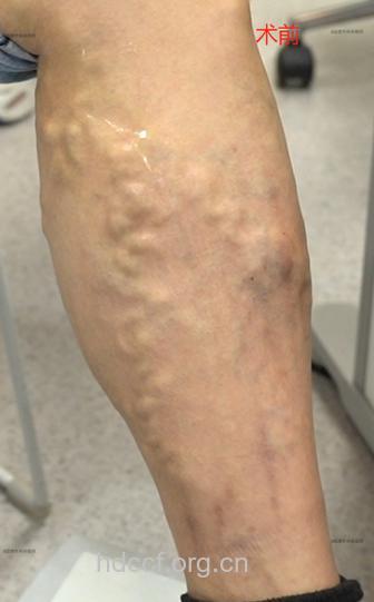 裤带长，糖尿病多