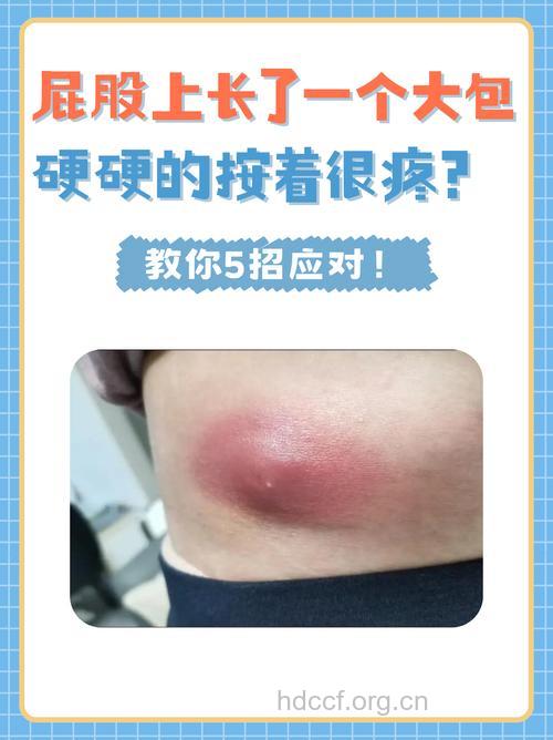 肥胖为什么容易长疖子