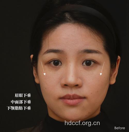 药物疗法瘦脸效果怎么样