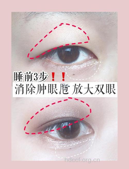 5招消除浮肿变小脸