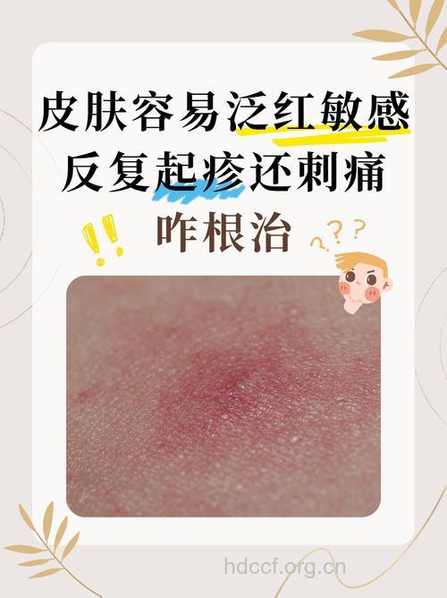 敏感性肌肤易发生过敏吗