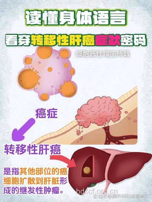 降低肝癌的转移和复发专家有招