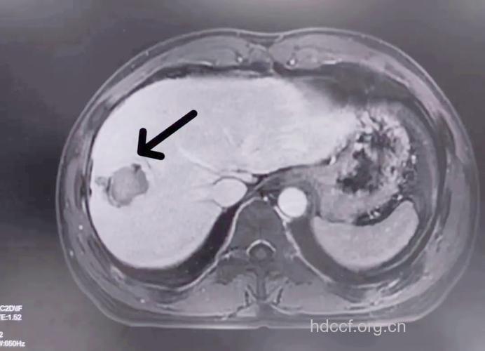 肝癌检查选用MRI还是CT
