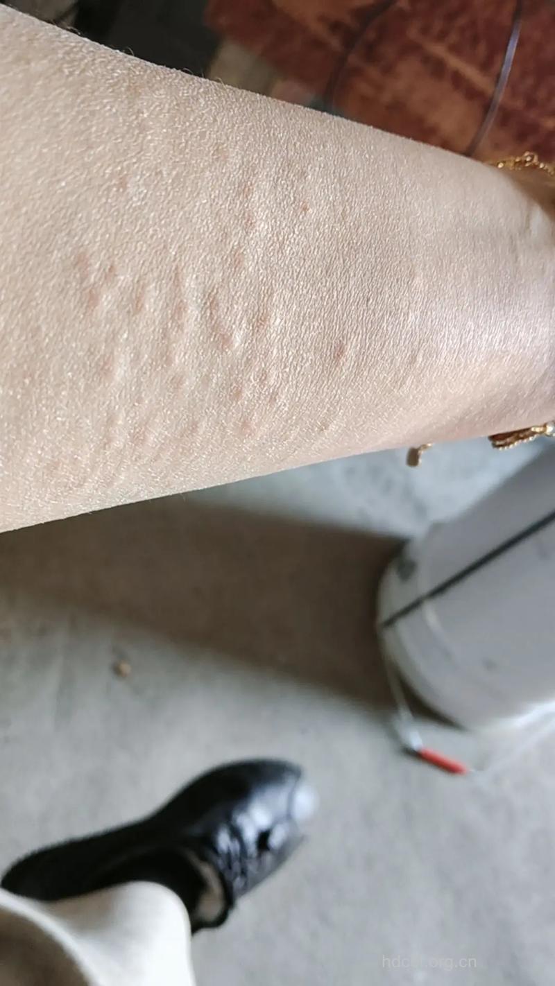 什么样的穿着易引起过敏呢