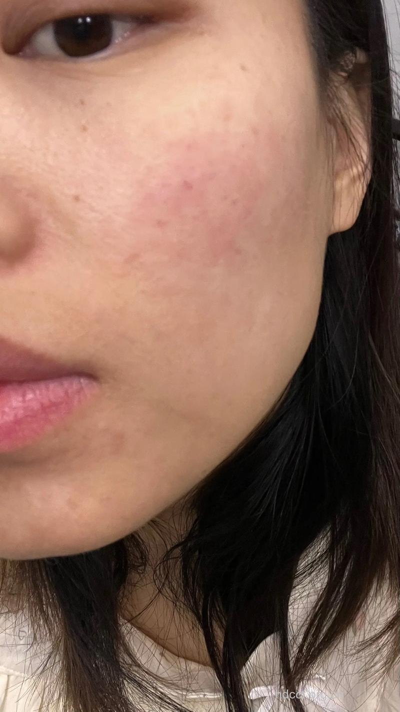 脸部皮肤过敏是什么引起的