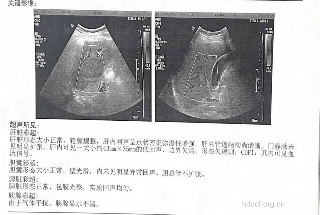 超声影像检查肝癌的五大依据