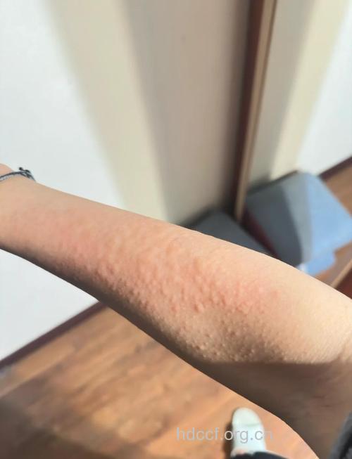 皮肤过敏是什么惹的祸