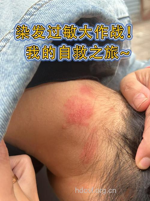 经常染发会过敏吗