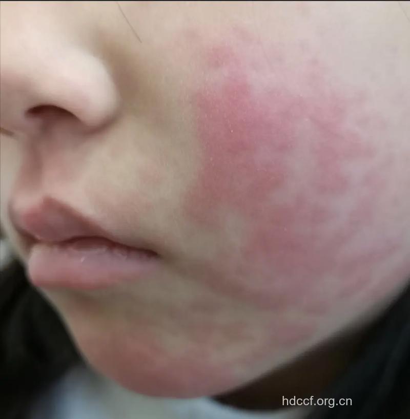 花粉会致皮肤过敏呢