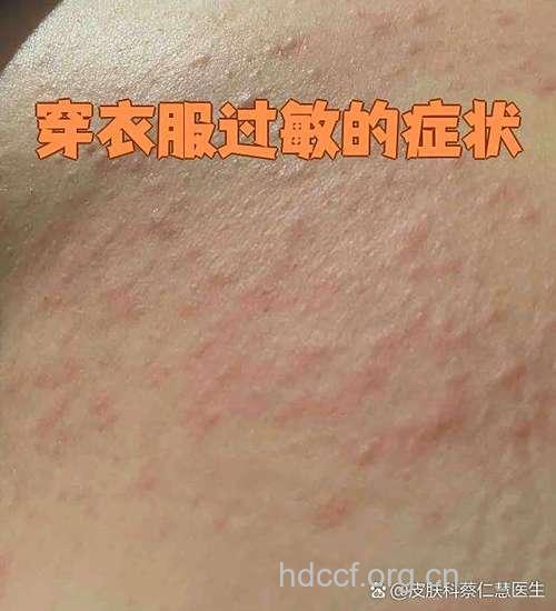 什么穿着更易引起过敏呢