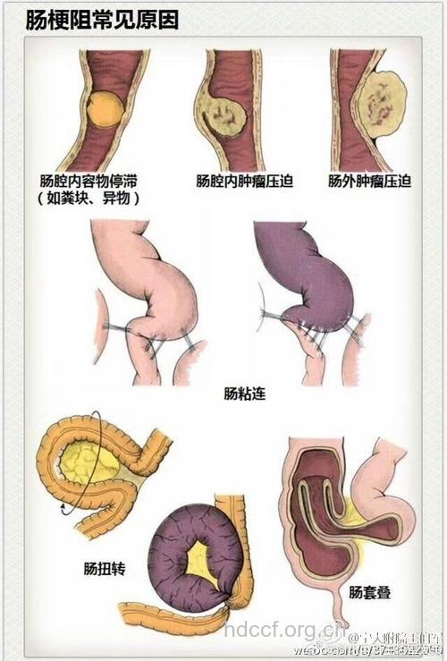 3类肠梗阻的形成原因分别是什么
