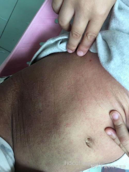 剖宫产婴儿皮肤易过敏吗