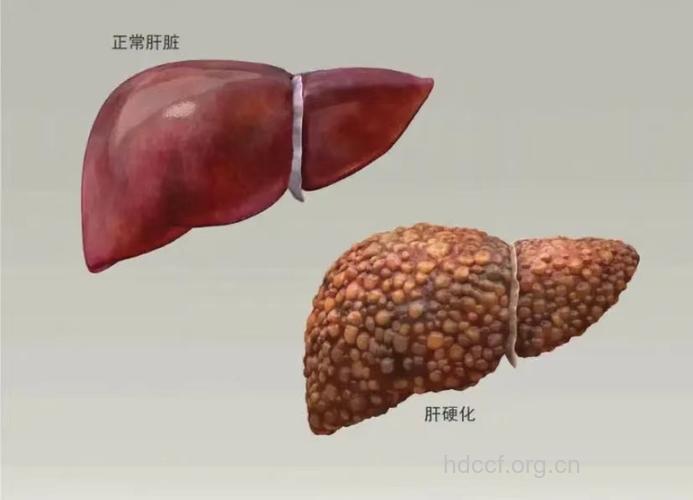 乙型肝炎又哪些肝外表现